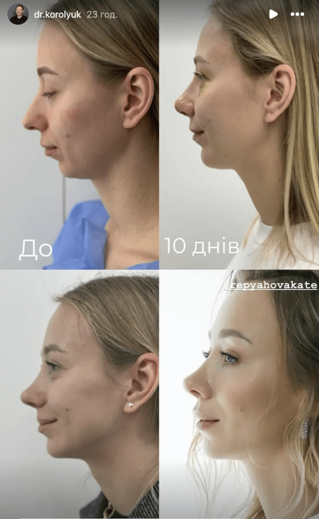 Дружину Віктора Павліка почали порівнювати з Тіною Кароль: як Репяхова виглядала до пластики
