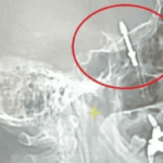 Стоматолог “нечаянно” вкрутил зубной имплантат в мозг пациента ➤ Prozoro.net.ua