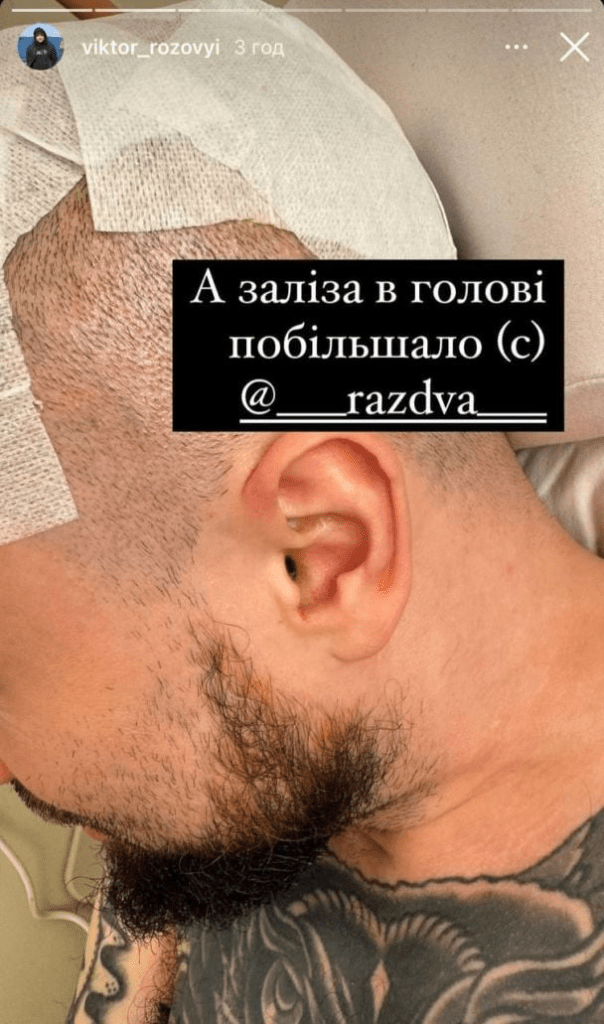 Зірці "Ліги сміху" вставили титанову пластину в череп: як виглядає його травма