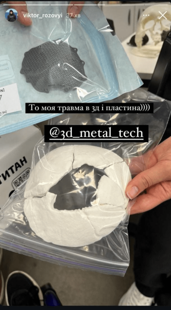 Зірці "Ліги сміху" вставили титанову пластину в череп: як виглядає його травма