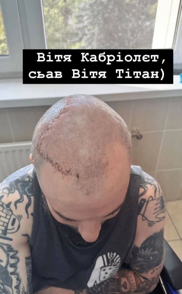 Комік та ветеран Віктор Розовий показав шрами після трепанації черепа 5 Комік та ветеран Віктор Розовий показав шрами після трепанації черепа