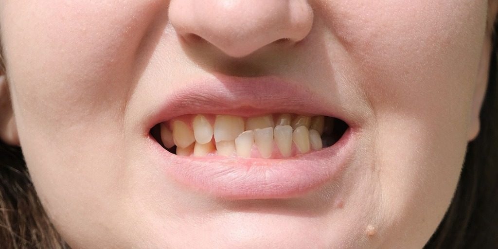 Как определить диабет по состоянию зубов: важные признаки