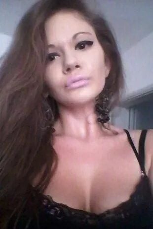 Ось який вигляд мала дівчина з найбільшими губами до операції