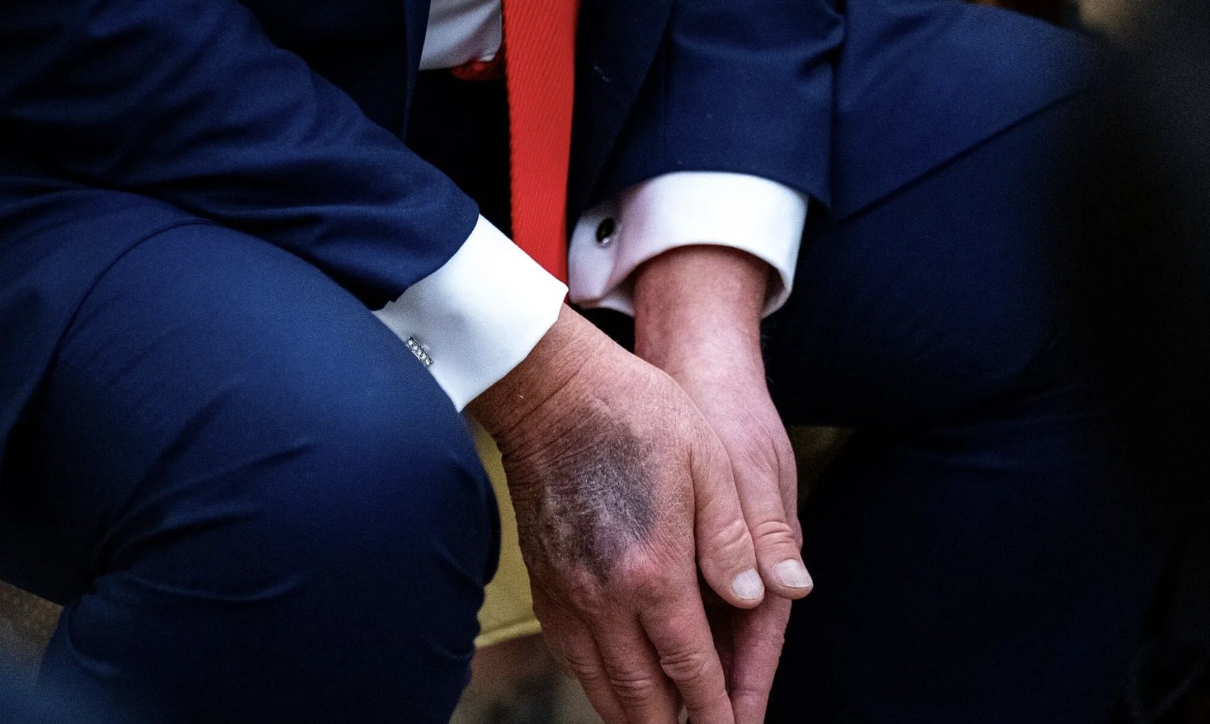 Трампу грозит ампутация: всплыли интересные детали