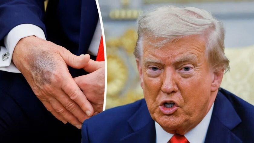 Трампу грозит ампутация: всплыли интересные детали ➤ Prozoro.net.ua