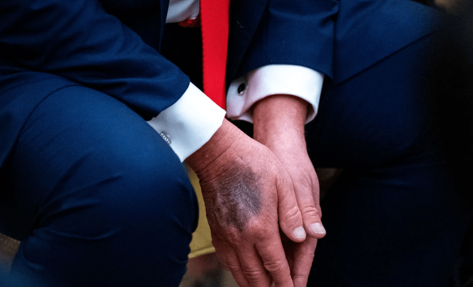 Трамп знову має проблеми: що відомо про хворобу президента США 3 Трамп знову має проблеми: що відомо про хворобу президента США