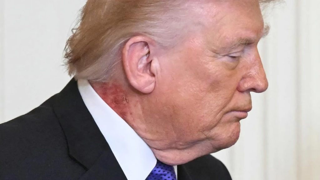 У США знову заговорили про хворобу Трампа через дивні плями на шиї (фото) 3 У США знову заговорили про хворобу Трампа через дивні плями на шиї (фото)